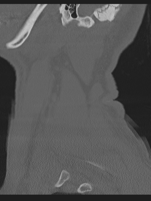 Cavernoma of cervical cord (Radiopaedia 50838-56346 Sagittal bone window 73).png