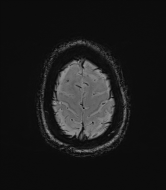 File:Cavernoma with bleed - midbrain (Radiopaedia 54546-60773 Axial SWI 43).png