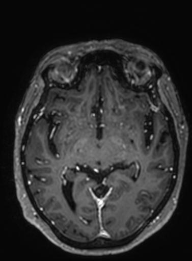 File:Cavernous hemangioma of the cerebellar falx (Radiopaedia 73025-83724 Axial T1 C+ 187).jpg
