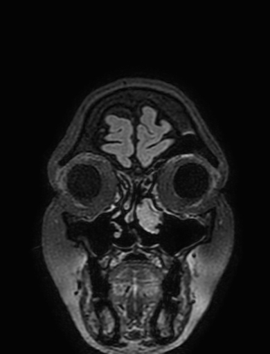 Cavernous hemangioma of the cerebellar falx (Radiopaedia 73025-83724 Coronal FLAIR 22).jpg