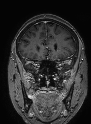 Cavernous hemangioma of the cerebellar falx (Radiopaedia 73025-83724 Coronal T1 C+ 110).jpg