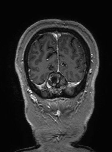 Cavernous hemangioma of the cerebellar falx (Radiopaedia 73025-83724 Coronal T1 C+ 336).jpg