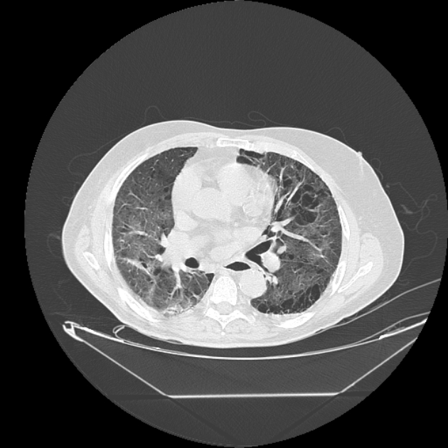 Cavitating bronchogenic carcinoma (Radiopaedia 44489-48162 Axial lung window 43).jpg