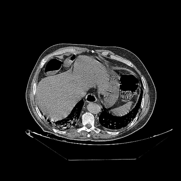 Cavitating bronchogenic carcinoma (Radiopaedia 44489-48162 Axial non-contrast 73).jpg