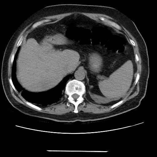 Cavitating pulmonary metastases (Radiopaedia 89545-106544 Axial non-contrast 51).jpg