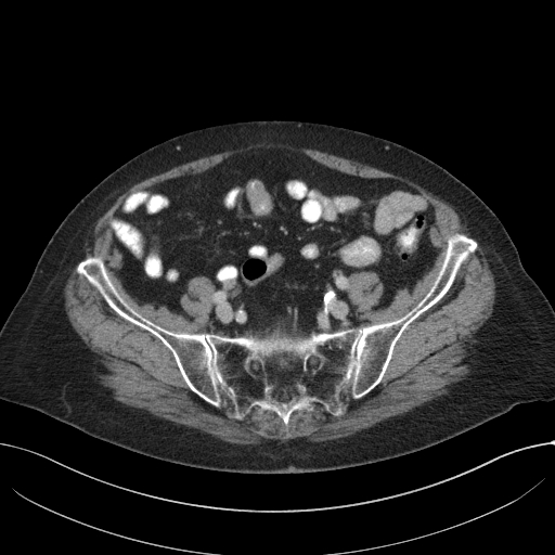 Cecal adenocarcinoma - surgical scar recurrence (Radiopaedia 79988-93264 C 53).jpg