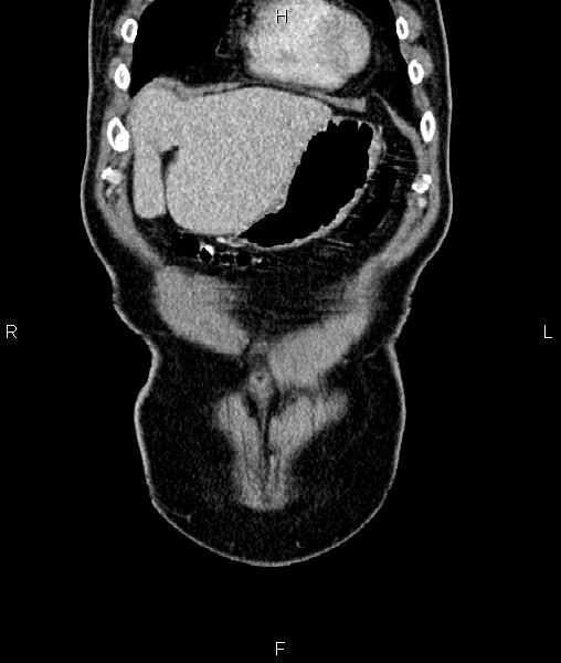 Cecal cancer with appendiceal mucocele (Radiopaedia 91080-108651 D 9).jpg
