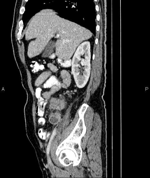 File:Cecal cancer with appendiceal mucocele (Radiopaedia 91080-108651 E 27).jpg