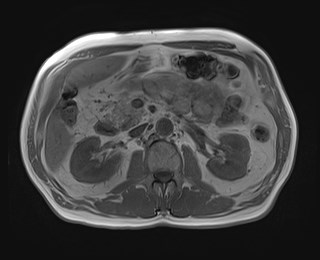 File:Cecal mass causing appendicitis (Radiopaedia 59207-66532 Axial T1 in-phase 57).jpg
