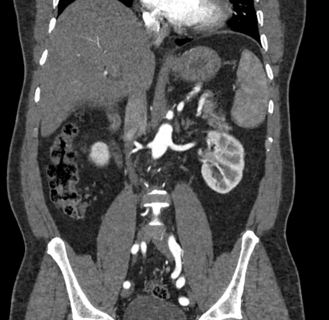 Celiac artery dissection (Radiopaedia 52194-58080 C 67).jpg