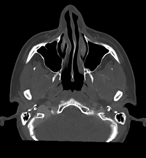 Cemento-ossifying fibroma (Radiopaedia 46243-50643 Axial bone window 27).png