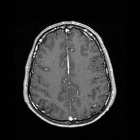 Central-variant posterior reversible encephalopathy syndrome (PRES) (Radiopaedia 43880-47358 Axial T1 C+ 120).jpg