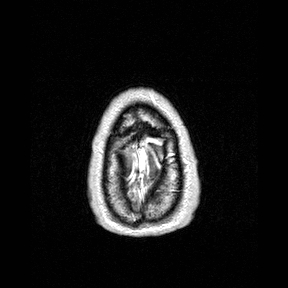 Central-variant posterior reversible encephalopathy syndrome (PRES) (Radiopaedia 43880-47358 Axial T1 C+ 164).jpg