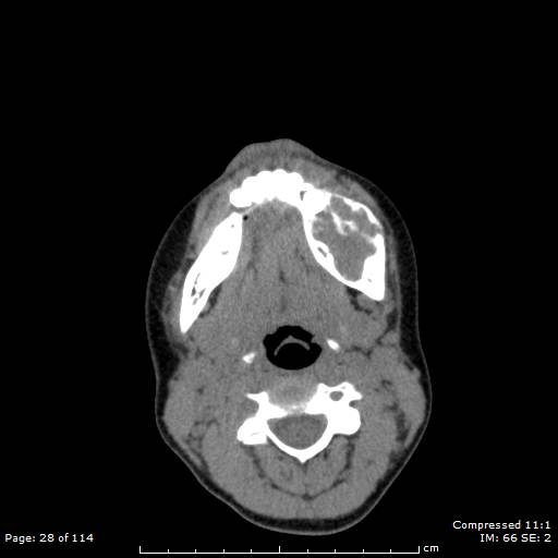 Central giant cell granuloma (Radiopaedia 45612-49754 Axial non-contrast 14).jpg
