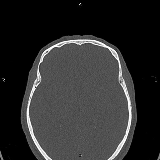 File:Central giant cell granuloma (Radiopaedia 83346-97761 Axial bone window 81).jpg