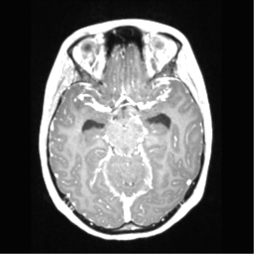 Central neurocytoma (Radiopaedia 37664-39557 Axial T1 C+ 32).png