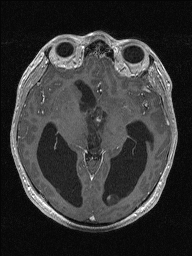 Central neurocytoma (Radiopaedia 56690-63469 Axial T1 C+ 70).jpg
