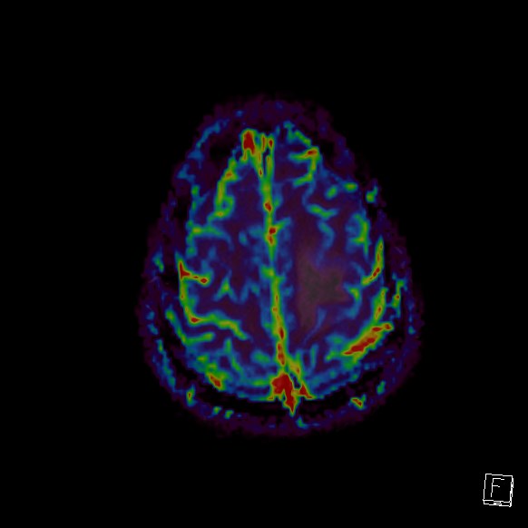Central neurocytoma (Radiopaedia 84497-99872 Axial Perfusion 47).jpg