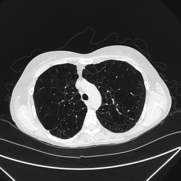 Centrilobular pulmonary emphysema (Radiopaedia 24495-24789 Axial lung window 30).jpg