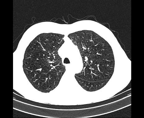 Centrilobular pulmonary emphysema (Radiopaedia 62468-70718 Axial lung window 23).jpg