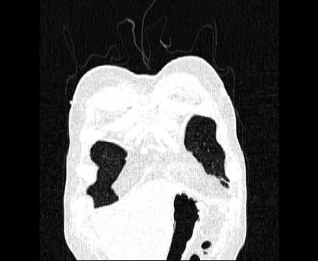 Centrilobular pulmonary emphysema (Radiopaedia 62468-70718 Coronal lung window 8).jpg