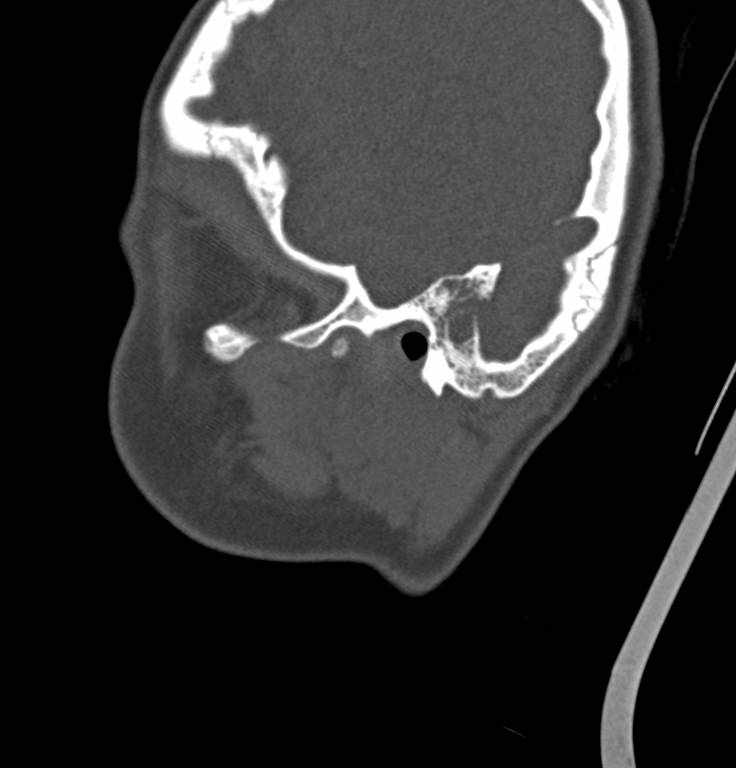Cerebellar abscess (Radiopaedia 73727-84527 Sagittal bone window 34).jpg