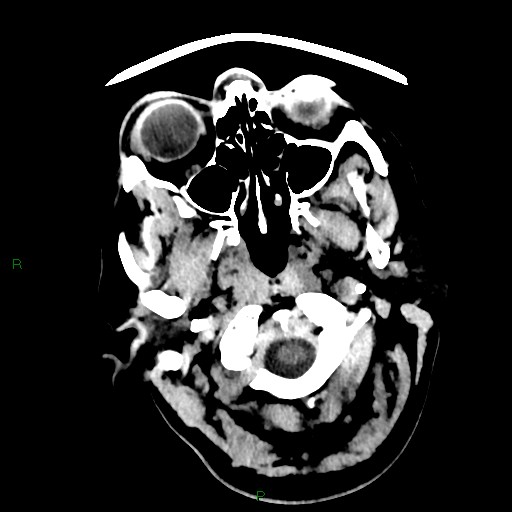 Cerebellar abscess (Radiopaedia 78135-90671 Axial non-contrast 3).jpg