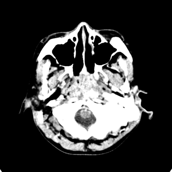 Cerebellar abscess secondary to mastoiditis (Radiopaedia 26284-26412 Axial C+ delayed 11).jpg