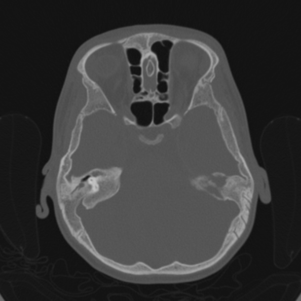 Cerebellar abscess secondary to mastoiditis (Radiopaedia 26284-26413 Axial bone window 67).jpg
