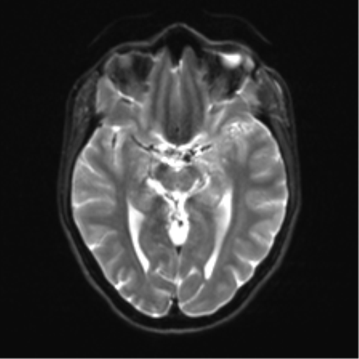 Cerebellar agenesis with hypoplastic pons (pontocerebellar hypoplasia) (Radiopaedia 57224-64138 Axial DWI 17).png