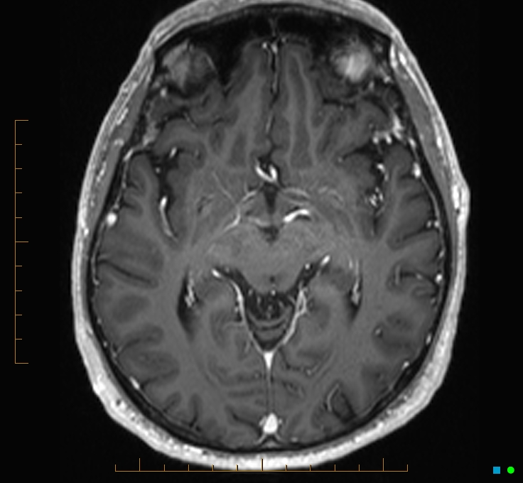 Cerebellar gangliocytoma (Radiopaedia 65377-74422 Axial T1 C+ 56).jpg