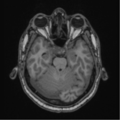 Cerebellar hemangioblastomas and pituitary adenoma (Radiopaedia 85490-101176 Axial T1 26).png