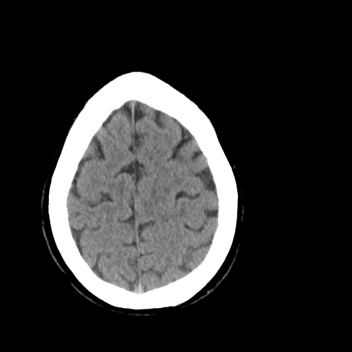 File:Cerebellar infarct due to vertebral artery dissection with posterior fossa decompression (Radiopaedia 82779-97029 Axial non-contrast 24).png