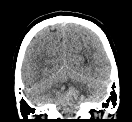 File:Cerebellar metastases - colorectal adenocarcinoma (Radiopaedia 40947-43652 Coronal non-contrast 71).png
