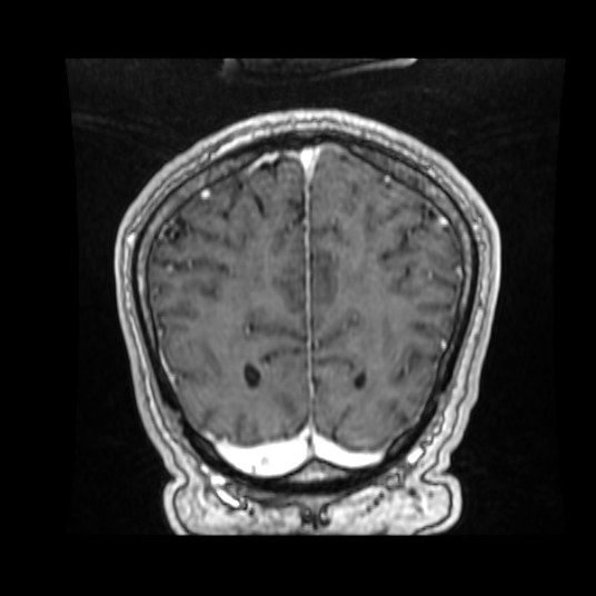 Cerebellar metastasis of pulmonary adenocarcinoma, cavernous venous malformation, and developmental venous anomaly (Radiopaedia 85827-101661 Coronal T1 C+ 28).jpg