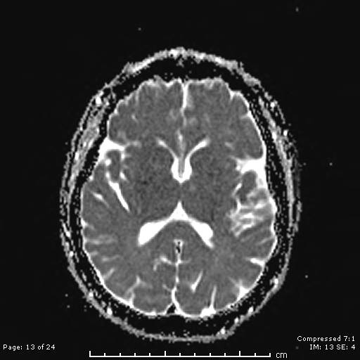 File:Cerebellar strokes due to intracranial giant cell arteritis (Radiopaedia 68799-81713 Axial ADC 13).jpg
