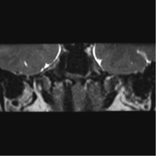 Cerebellopontine angle meningioma (Radiopaedia 48434-53348 Coronal T2 72).png