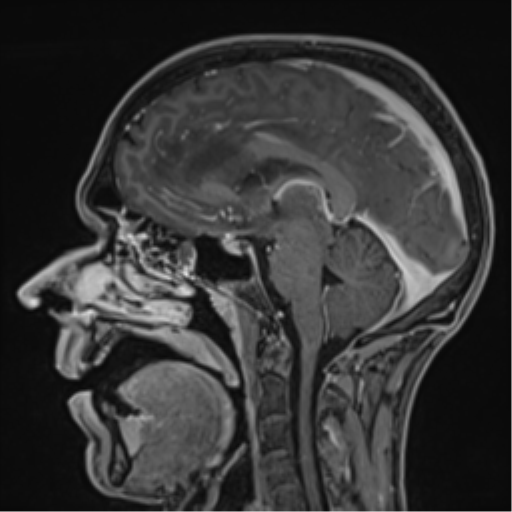 Cerebral abscess (Radiopaedia 60342-68009 J 28).png