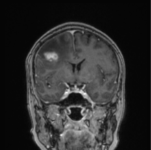 Cerebral abscess from pulmonary arteriovenous malformation (Radiopaedia 86275-102291 L 54).png