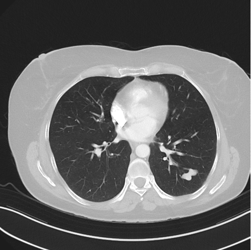 Cerebral abscess from pulmonary arteriovenous malformation (Radiopaedia 86275-102292 Axial lung window 34).png