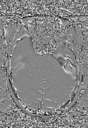 File:Cerebral amyloid angiopathy (Radiopaedia 29129-29518 Axial SWI Phase 11).jpg