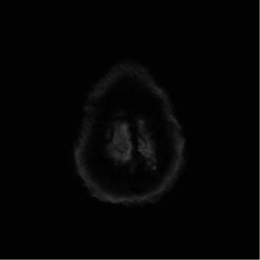 File:Cerebral amyloid angiopathy (Radiopaedia 46082-50433 Axial DWI 54).png