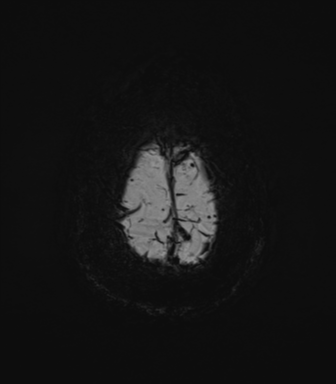 Cerebral amyloid angiopathy (Radiopaedia 46082-50433 Axial SWI MIP 75).png
