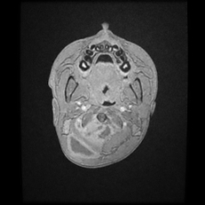 Cerebral and spinal tuberculosis (Radiopaedia 90489-107837 Axial T1 C+ 10).jpg
