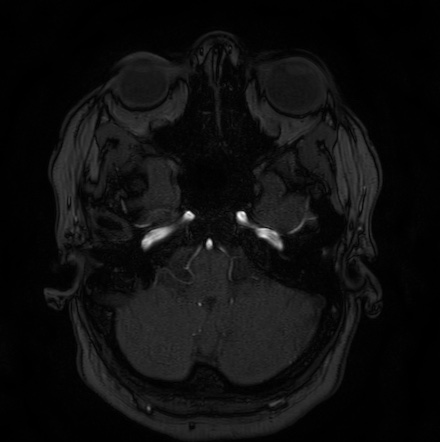 Cerebral arteriovenous malformation (Radiopaedia 74411-85654 Axial MRA 13).jpg