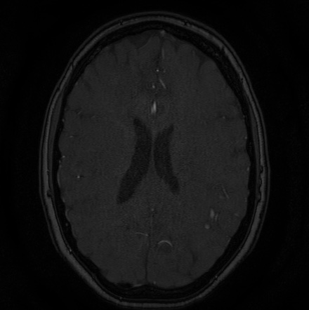 Cerebral arteriovenous malformation (Radiopaedia 74411-85654 Axial MRA 98).jpg