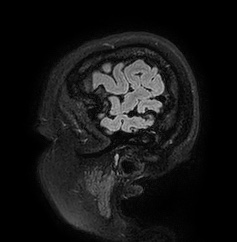 Cerebral arteriovenous malformation (Radiopaedia 74411-85654 Sagittal FLAIR 8).jpg