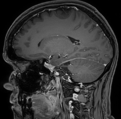 Cerebral arteriovenous malformation (Radiopaedia 74411-85654 Sagittal T1 C+ 51).jpg
