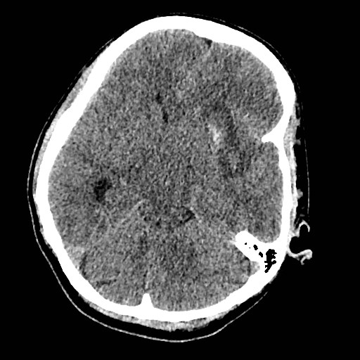 Cerebral arteriovenous malformation (Radiopaedia 79677-92887 Axial non-contrast 12).jpg