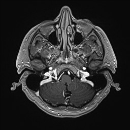 Cerebral arteriovenous malformation (Radiopaedia 84015-99245 Axial T1 C+ 33).jpg
